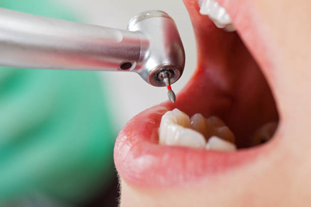 Best Broken or Cracked Tooth Emergency Dentist in East Quogue, NY